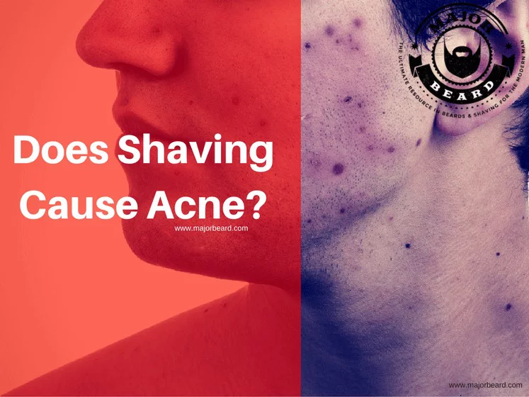 Does Shaving Cause Acne?